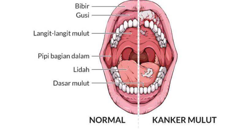 Ciri-ciri Kanker Mulut pada Anak yang Wajib Diwaspadai